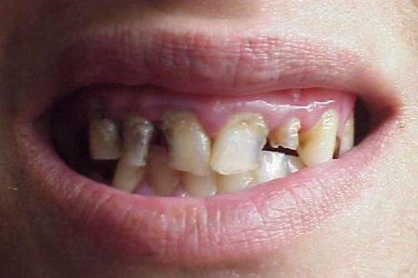 teeth 3a